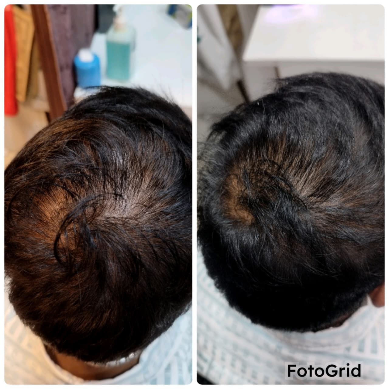 Hair loss treatment before and after — GFC and PRP, Mumbai