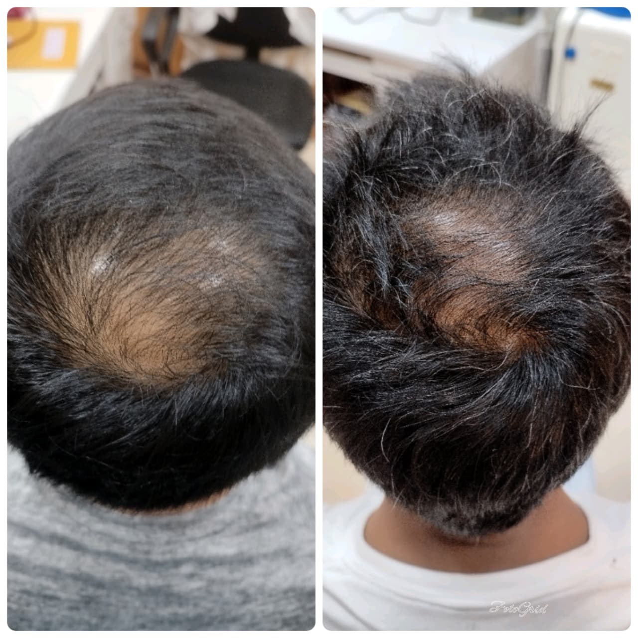 GFC hair fall treatment result before and after, Goregaon West