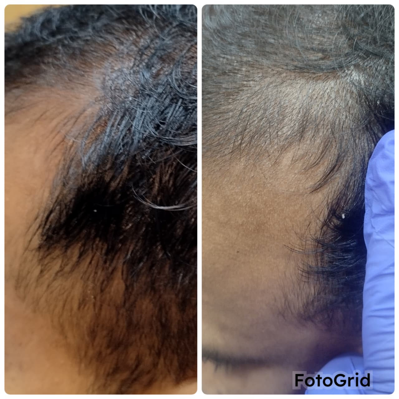 PRP hair restoration before and after result, Mumbai