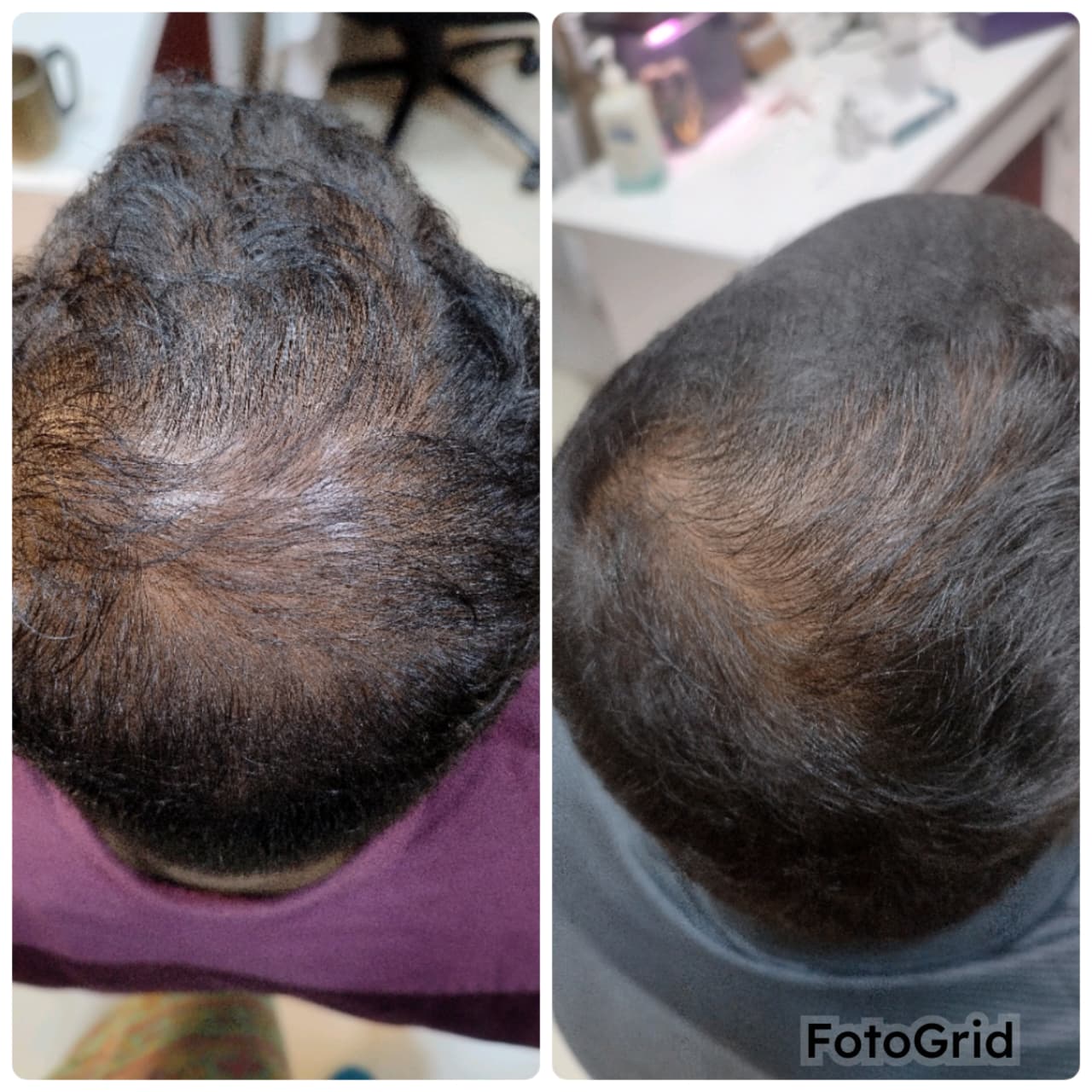 Hair regrowth before and after regenerative treatment, Goregaon West