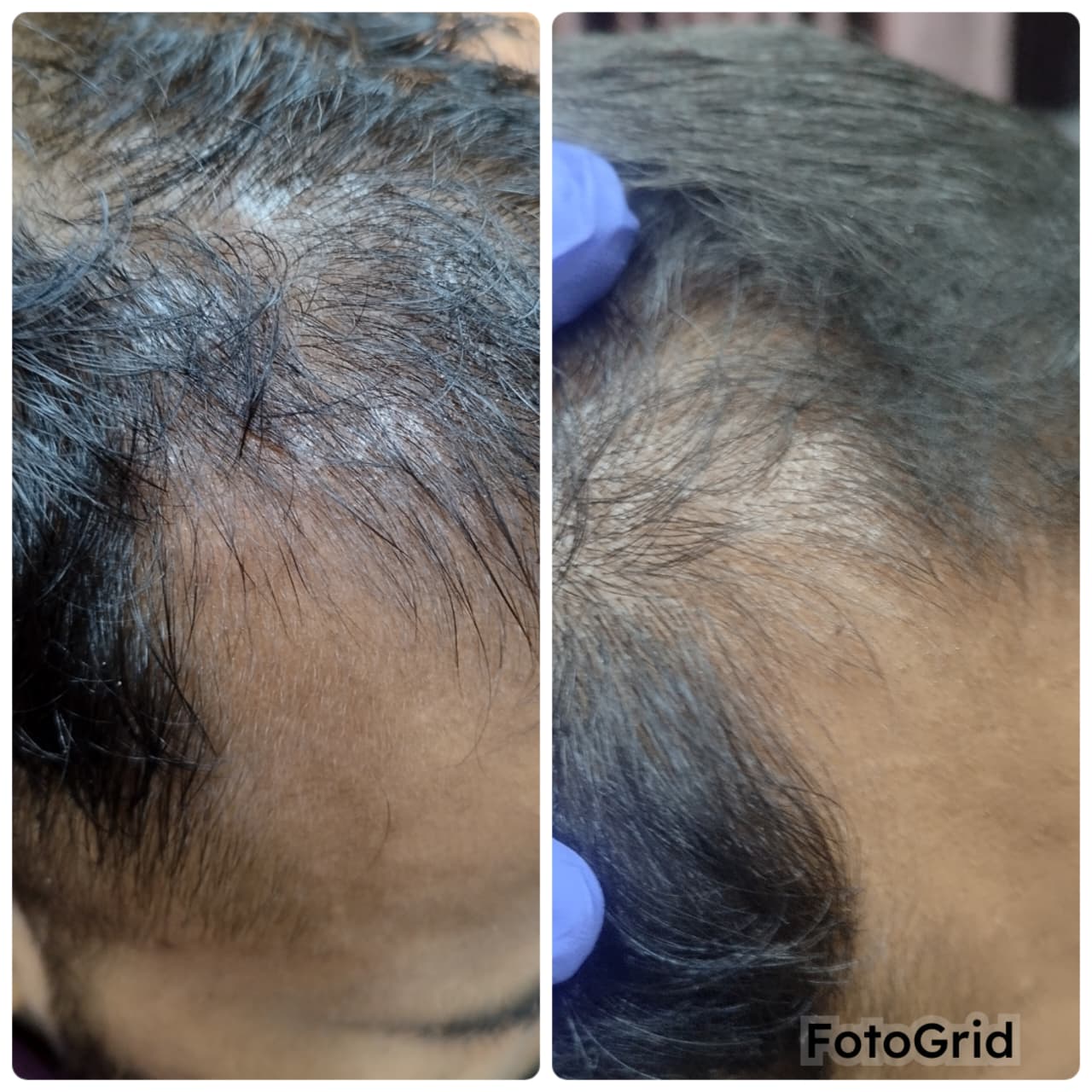 Hair fall control before and after GFC treatment, Mumbai