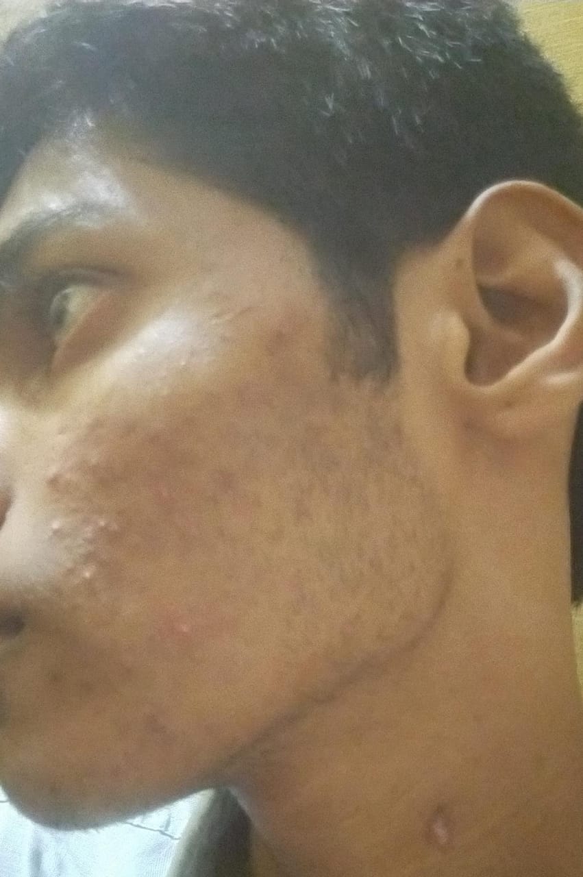 Acne after treatment — clearer skin at Dr. Faraah's Clinic, Goregaon West