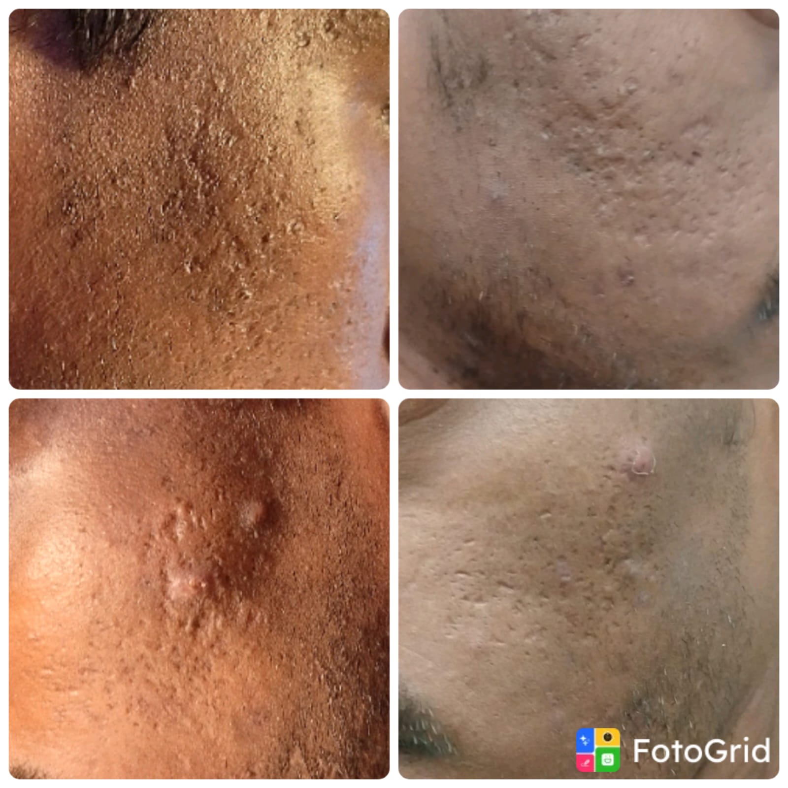Exosome treatment for acne scars before and after in Mumbai