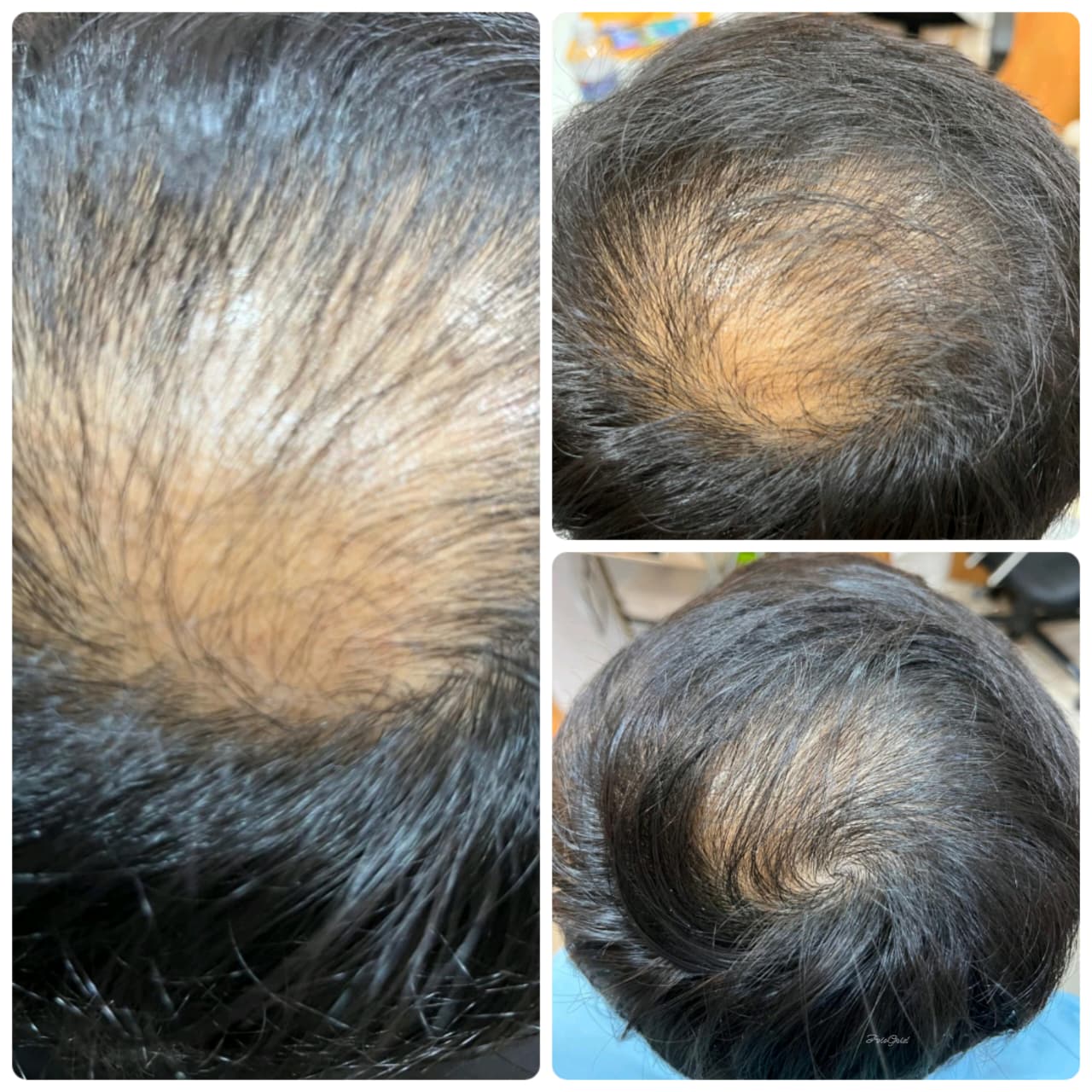 Hair regrowth before and after GFC treatment, Goregaon West Mumbai