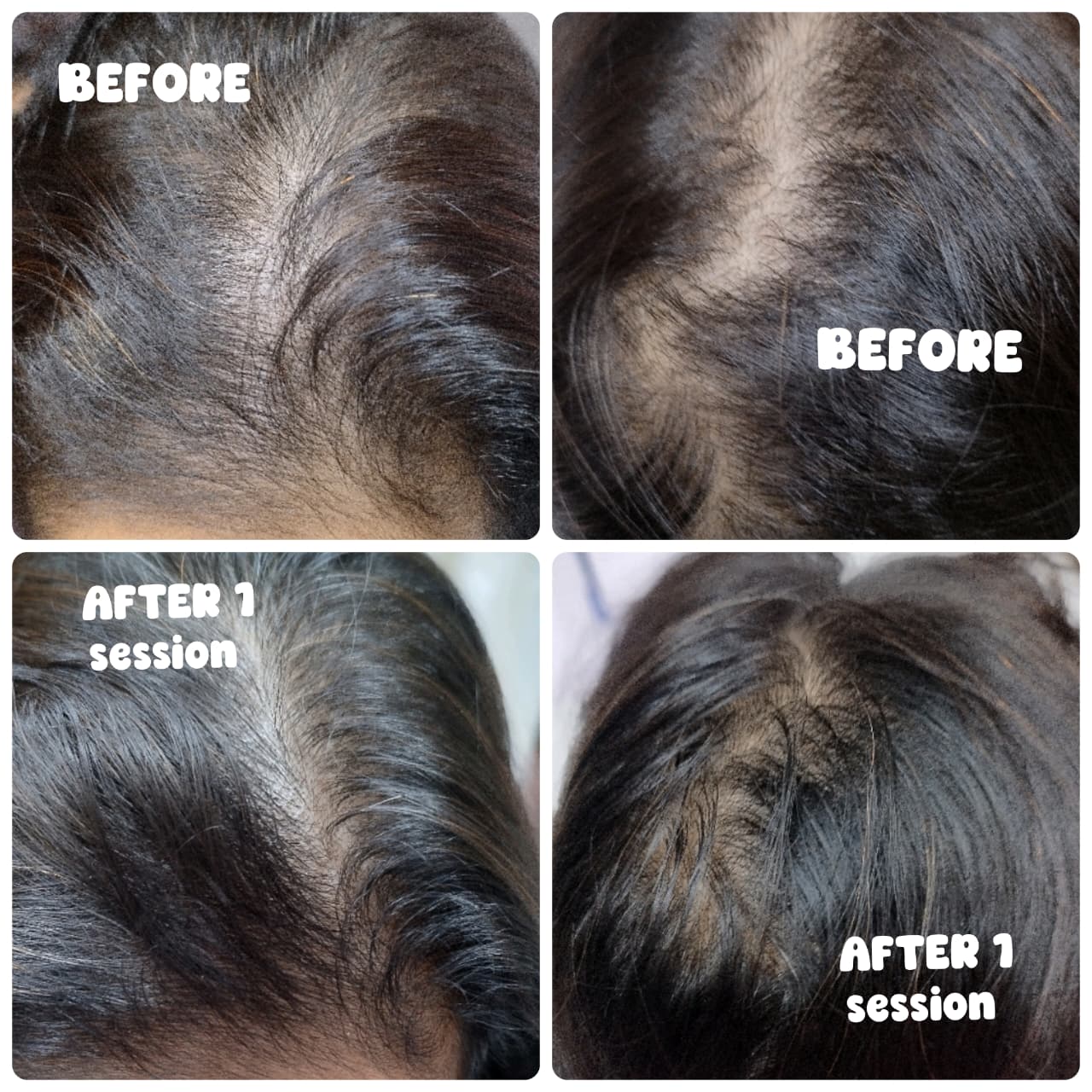 GFC hair treatment before and after result at Dr. Faraah's Clinic