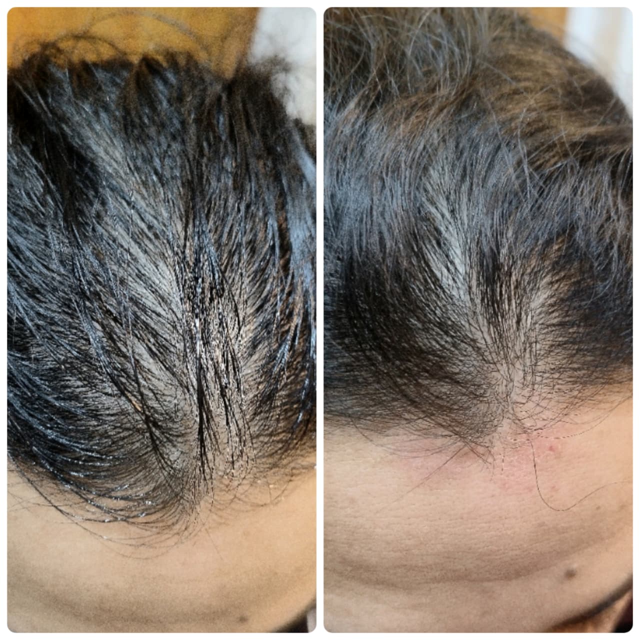 GFC hair restoration before and after result at Dr. Faraah's Clinic, Goregaon West