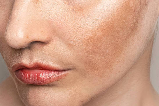 Melasma and pigmentation treatment at Dr. Faraah's Cosmetic & Laser Clinic, Goregaon West, Mumbai