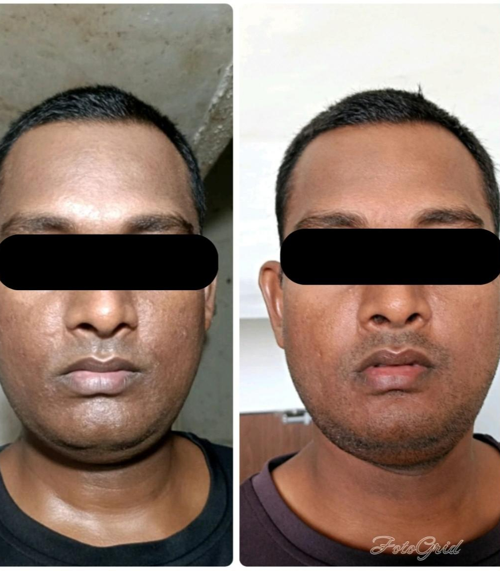 Q-Switch laser treatment before and after result at Dr. Faraah's Clinic, Goregaon West, Mumbai