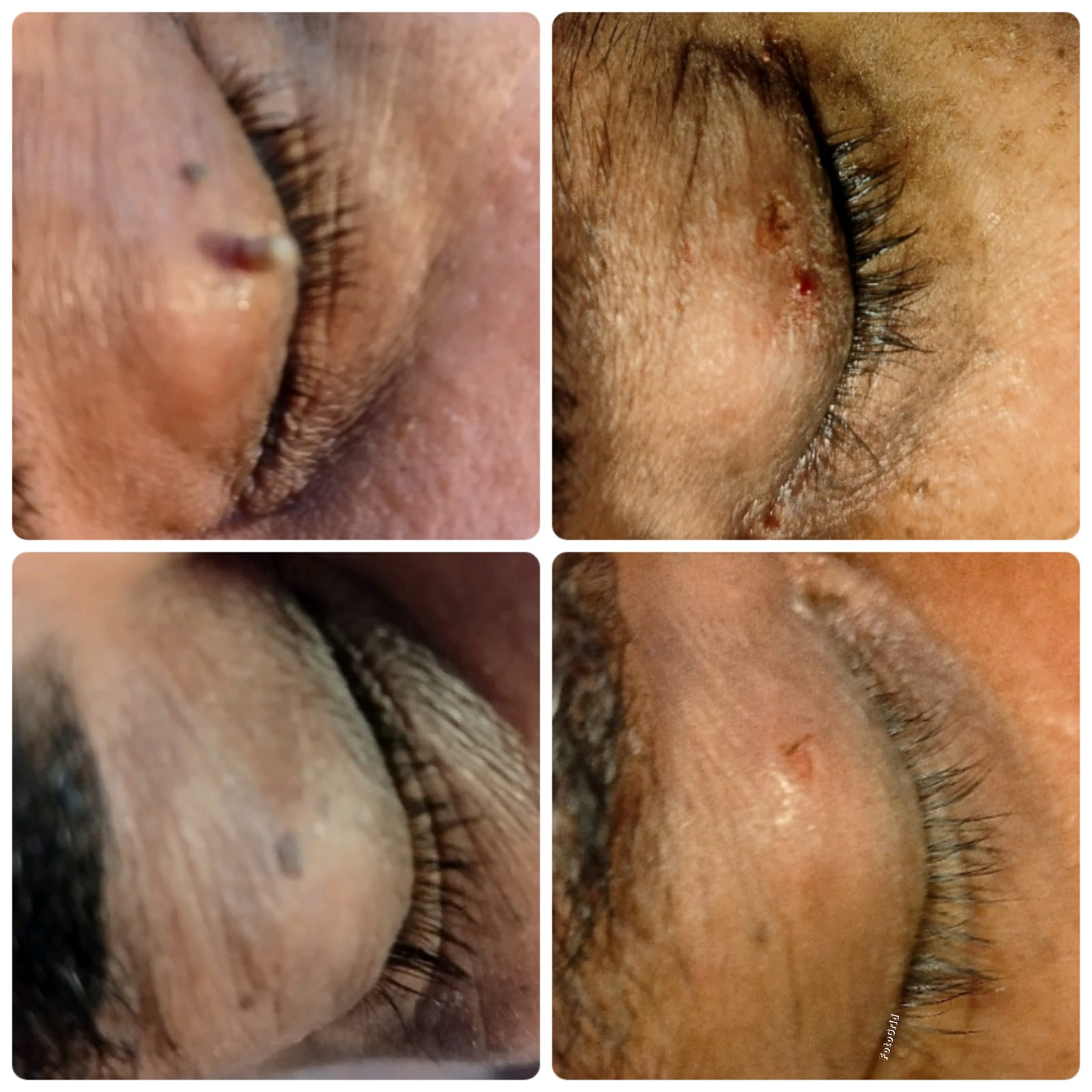 Wart removal before and after result at Dr. Faraah's Clinic, Goregaon West, Mumbai