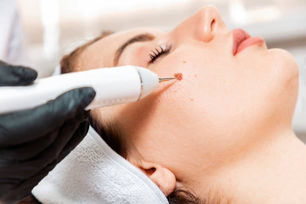Wart, mole and skin tag removal at Dr. Faraah's Cosmetic & Laser Clinic, Goregaon West, Mumbai