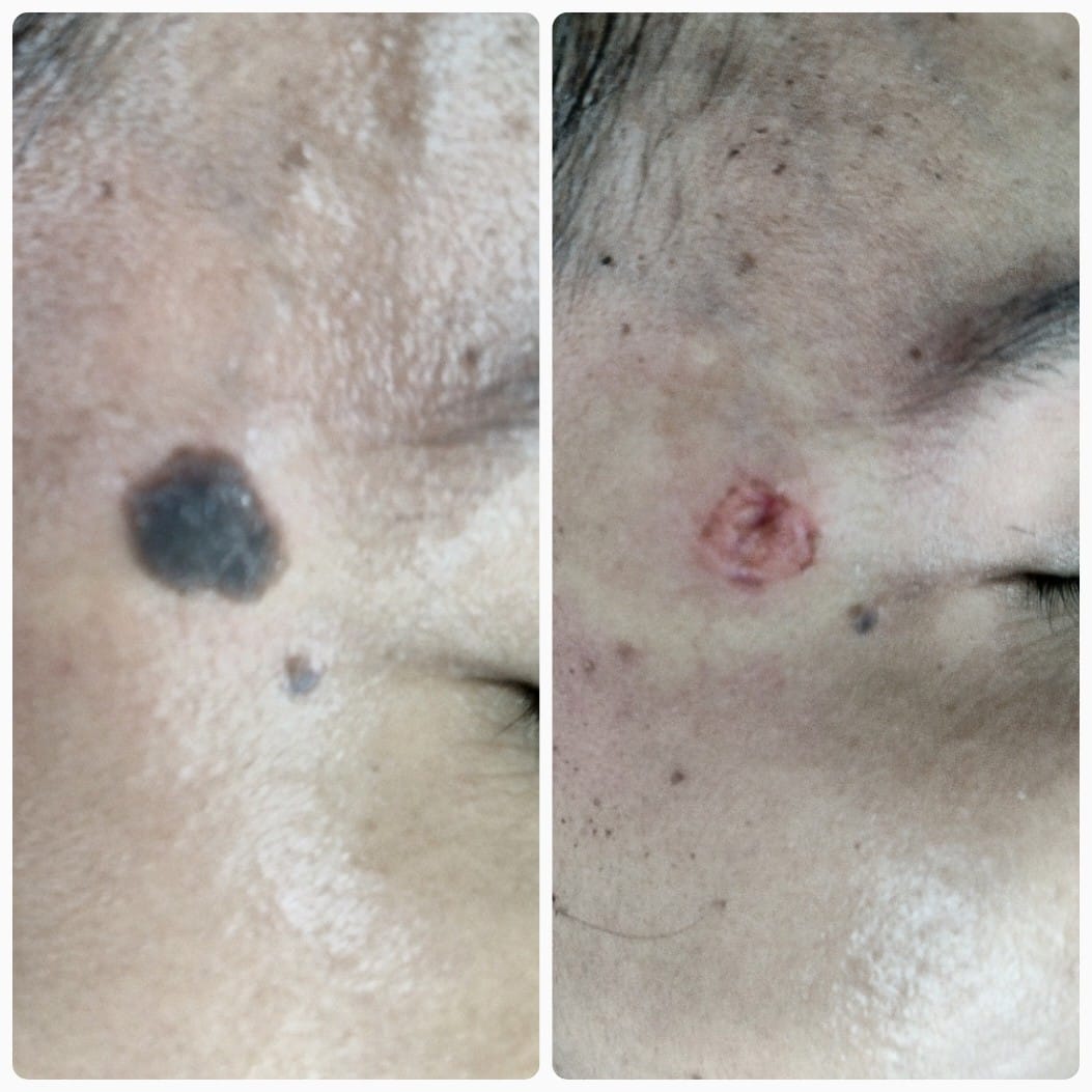 Flat mole removal before after